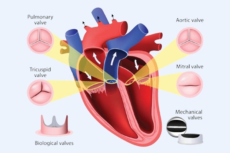 Heart Valve surgery