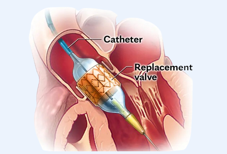 TAVI (Transcatheter Aortic Valve Implantation) 
